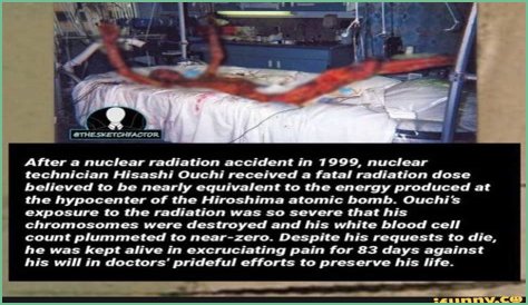 The Devastating Aftermath: Hisashi Ouchi's Autopsy Reveals Extent Of Radiation Damage